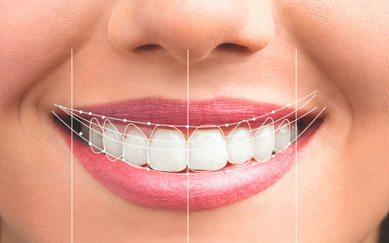 diseno de sonrisa digital