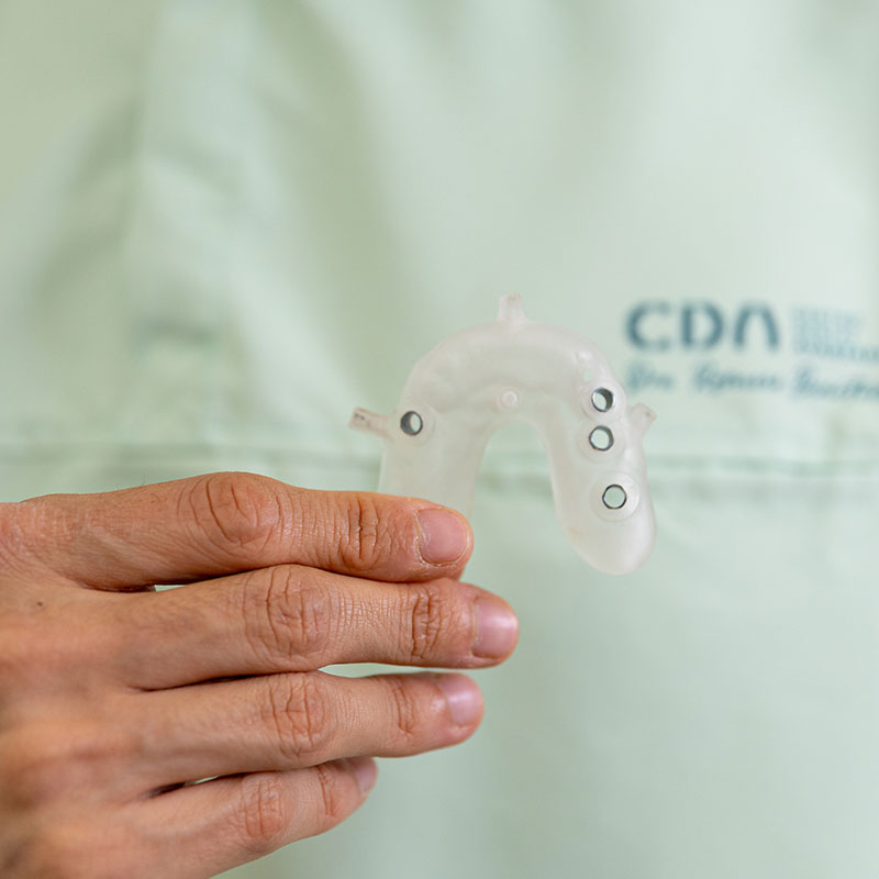 ferula dental de cirugia guiada - ferula quirurgica