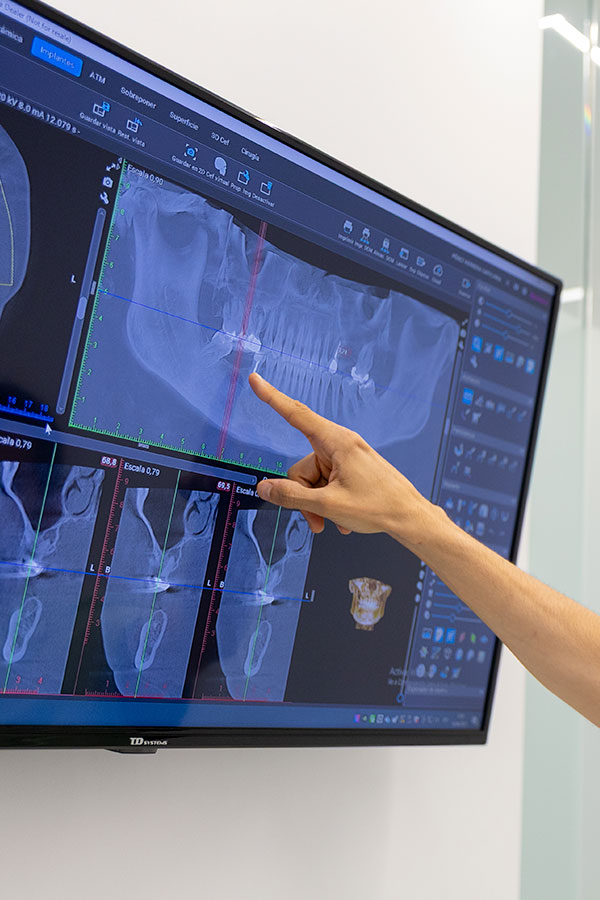 implante dental sin hueso