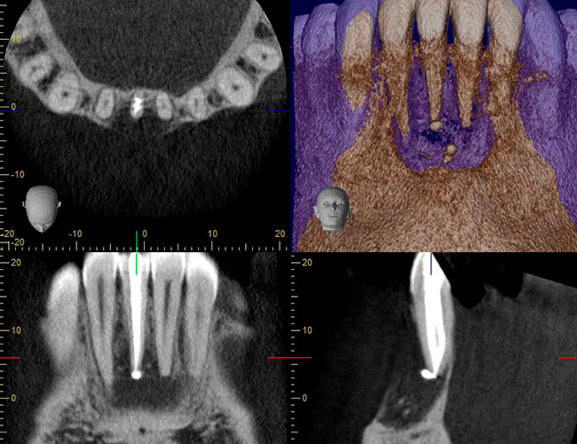 radiografia endodoncia