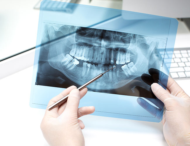 radiografia periapical endodoncia